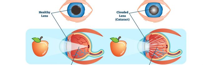 What is a Cataract? Different Types and Symptoms